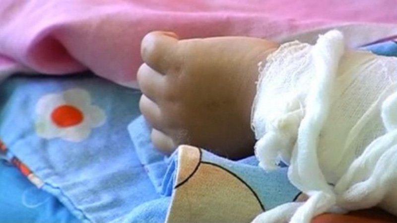 Маленькой Дарине сделали пересадку кожи, но предстоит долгий путь реабилитации