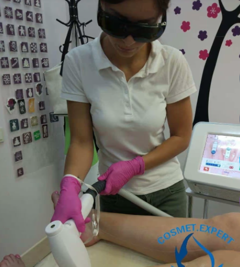 Diode Laser Hair Removal in London